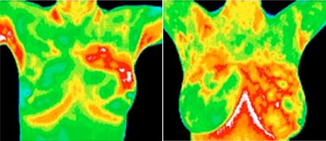 Różne zmiany nowotworowe w kobiecych piersiach